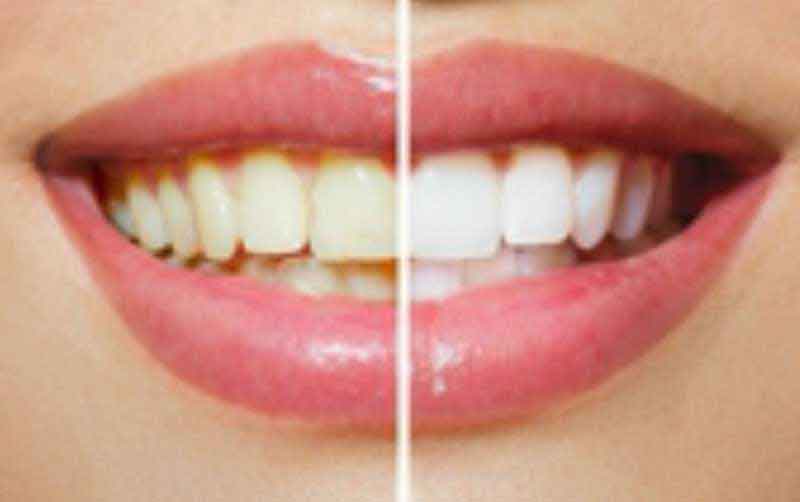 Top 25 Quotes On price of veneers in India